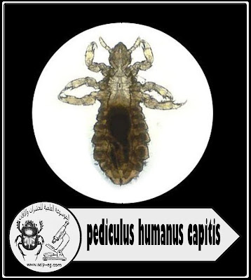 قمل الرأس Head lice - pediculus humanus capitis