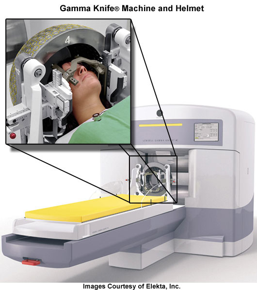Team AVM Gamma Knife Surgery One of the Most Effective Solutions for