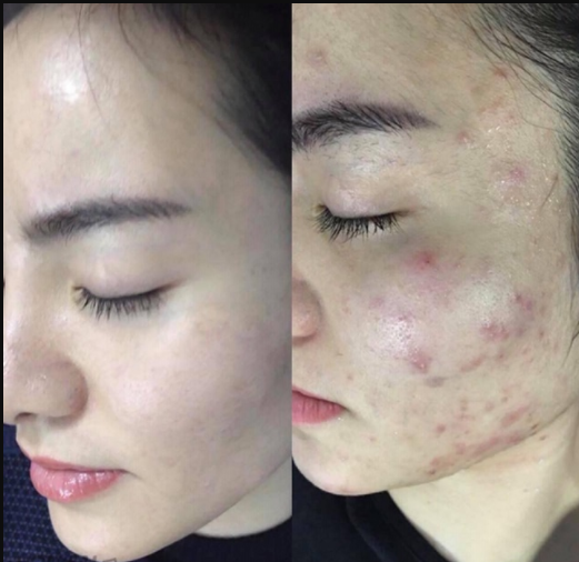 derma forte co tri tham khong