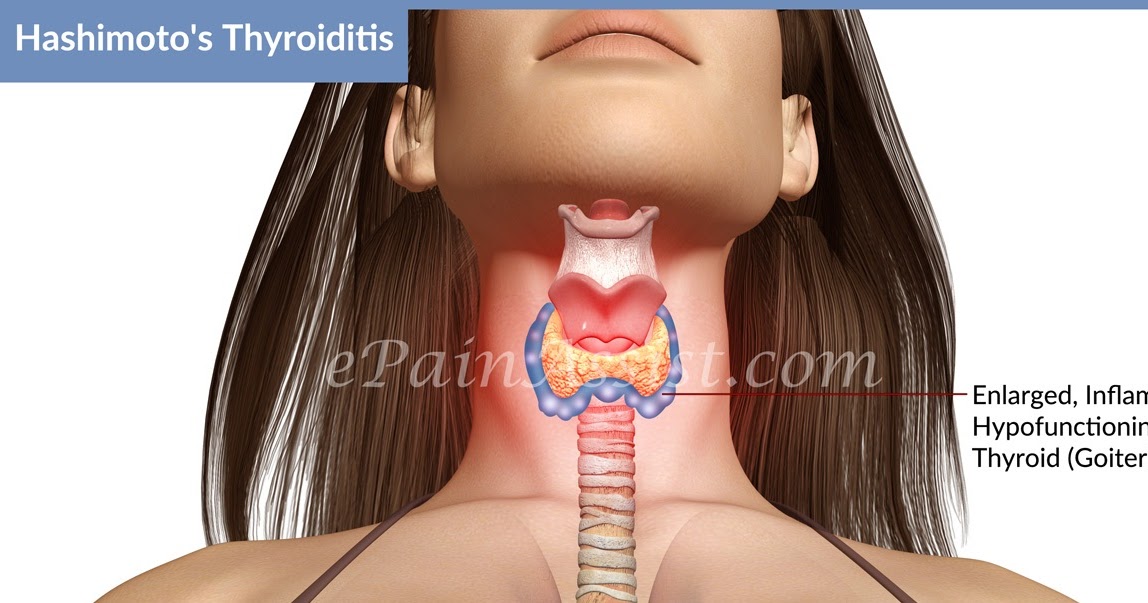 Alimentacion tiroiditis de hashimoto