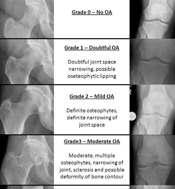 Visão Radiológica Classificação de Osteoartrose KellgrenLawrence