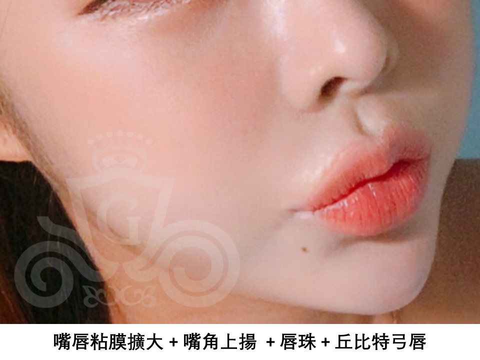 凱奇美女公主日記catch Meinv 明星唇部整形的秘诀 嘴角上揚 微笑唇 豐唇手術