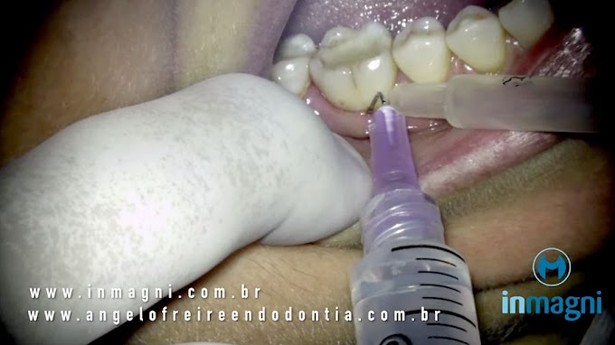ENDODONTIA: Endo de molar com lesão perirradicular - importância do ultrassom