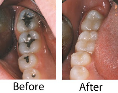 Silver mercury dental fillings removed.