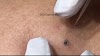 Black Head Removal (VIDEO) Pimple Popping