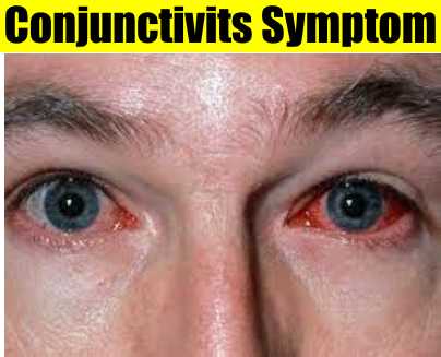 Conjunctivitis Pink Eyes Symptoms