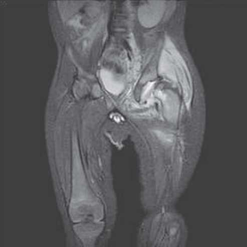 example of osteomyelitis