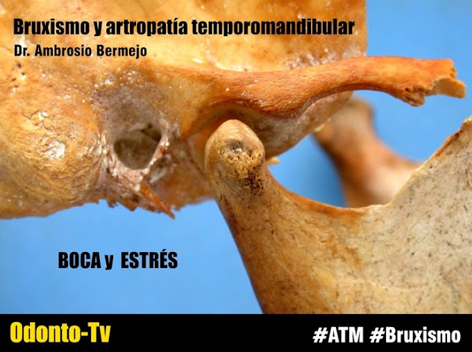 BOCA Y ESTRÉS: Bruxismo y artropatía temporomandibular - Dr. Ambrosio Bermejo