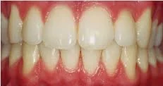 تبيض تجميل الاسنان والتخلص من الاصفرار teeth whitening