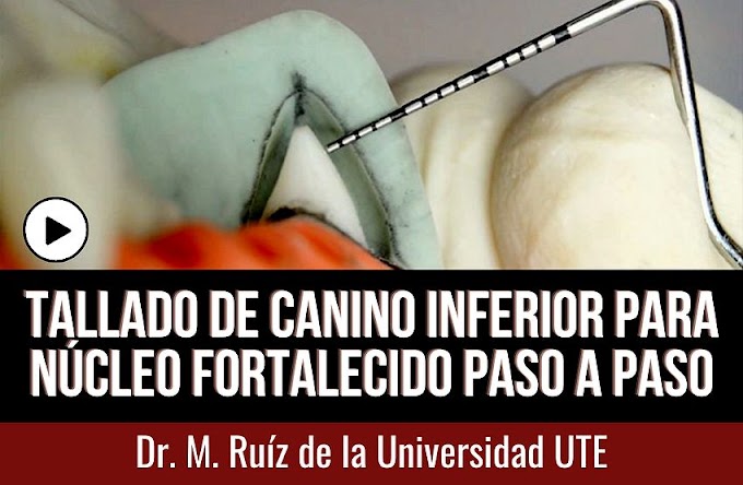 PRÓTESIS FIJA: Tallado de canino inferior para núcleo fortalecido Paso a Paso - Dr. M. Ruíz de la Universidad UTE