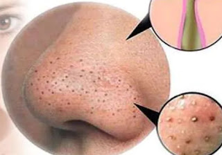 Don’t Squeeze the blackhead