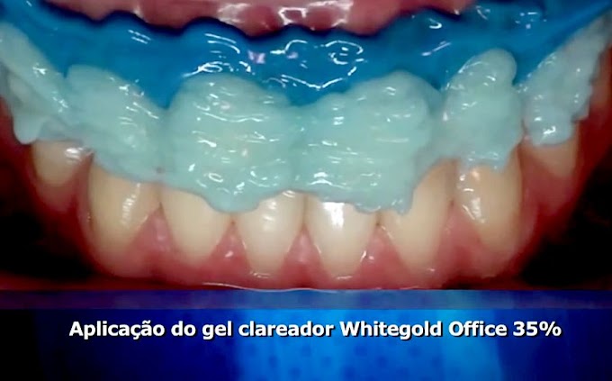 WHITEGOLD OFFICE: Sistema de Clareamento Dental de consultório à base de Peróxido de Hidrogênio 35%