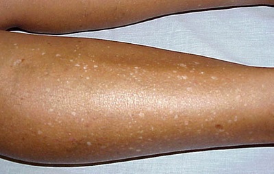 mezcla pozo Realizable Dermatología en la Costa del Sol: Hipomelanosis en gotas. Esas pequeñas manchas  blancas en la piel
