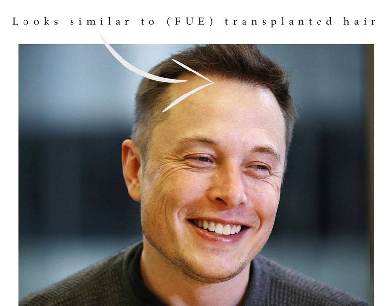 Elon grimes musk together Cure against baldness: Inside Elon Musk’s Hair Transformation – How Did He Do It?