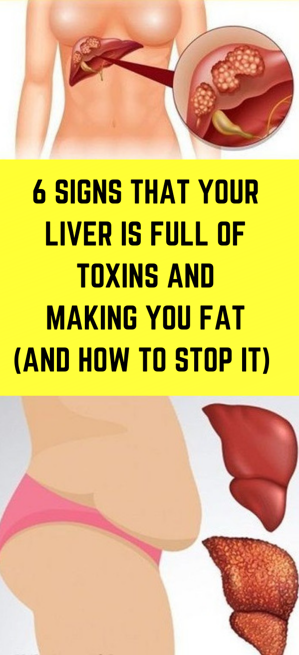 6 SIGNS THAT YOUR LIVER IS FULL OF TOXINS AND MAKING YOU FAT (AND HOW