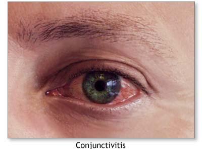 Ainun Theraphy PRI - Terapi Mata Eye Therapy: May 2013
