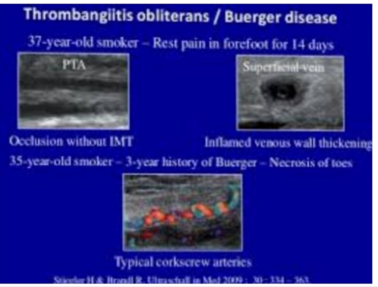 Buerger’s Disease