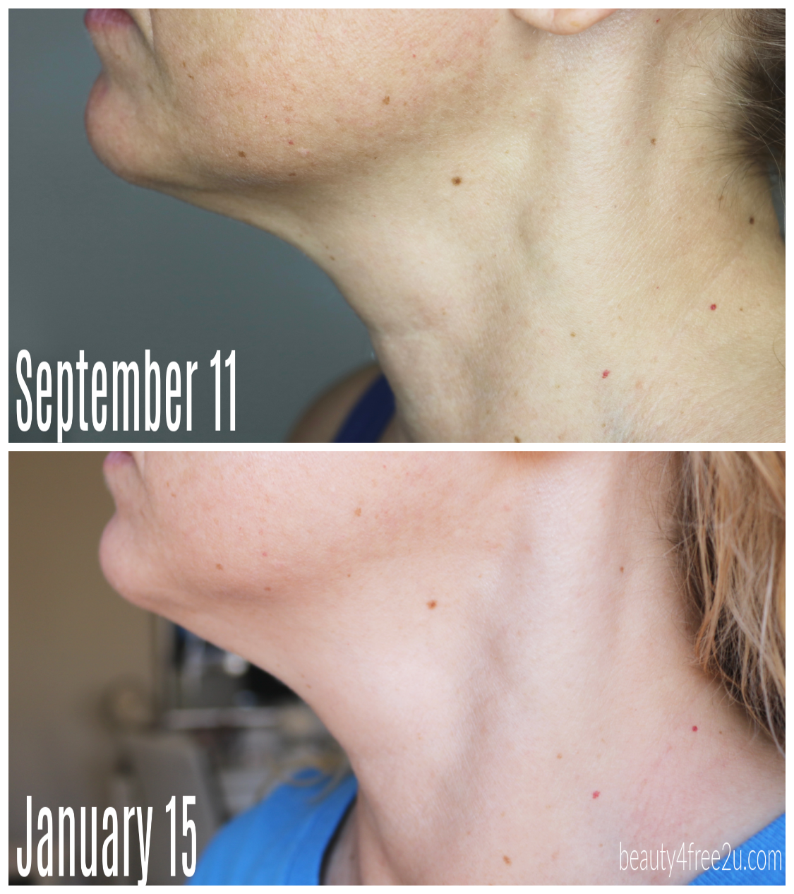 I used the NuFACE device for 120 days and THIS HAPPENED!