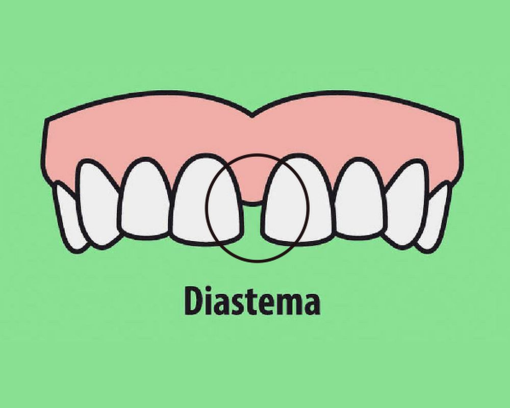 ¿Cómo corregir los dientes separados? Opciones de tratamiento ¿Cómo corregir los dientes separados? Opciones de tratamiento