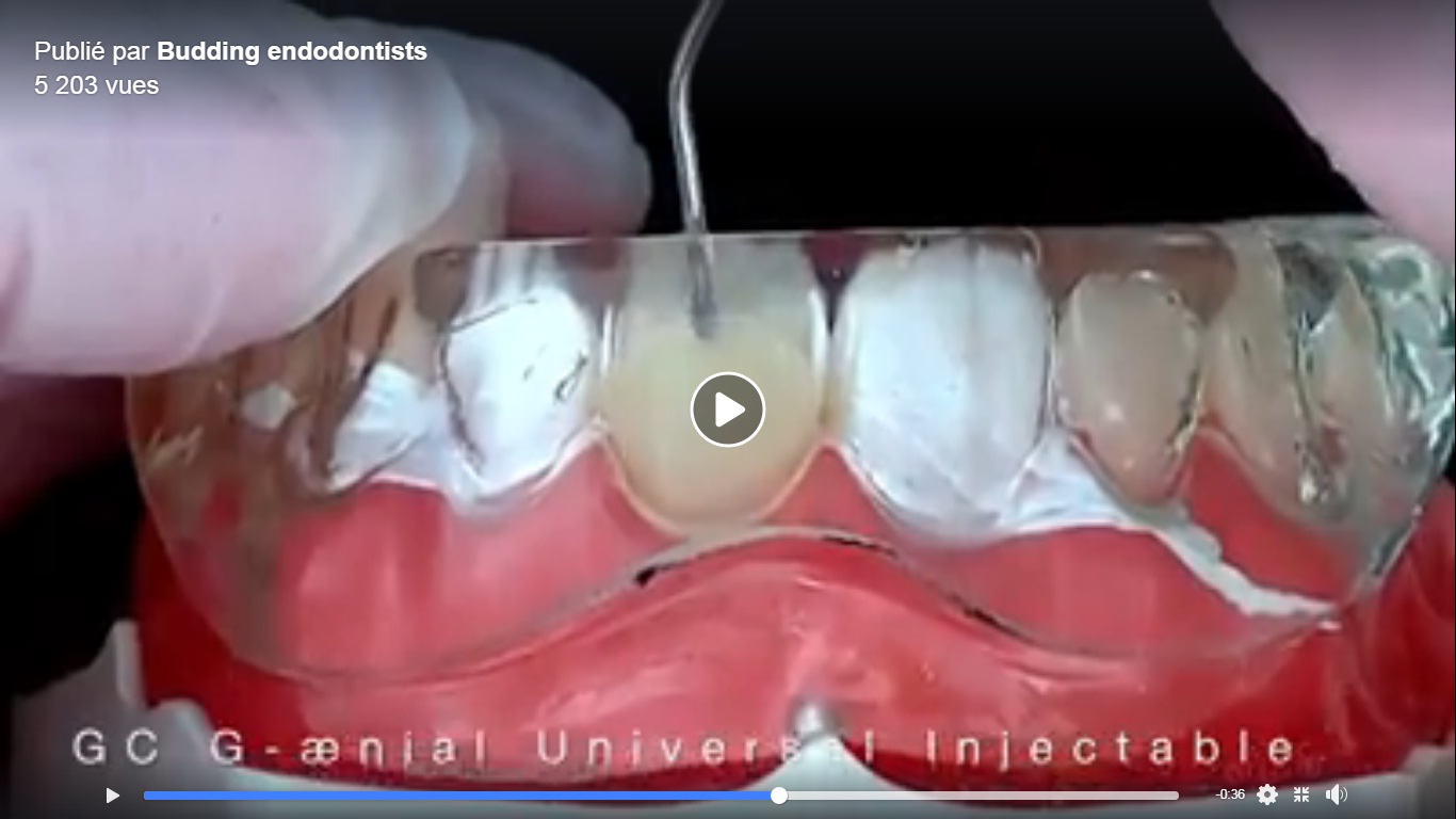 Injection molding technique Video 1min34 Dental Pro