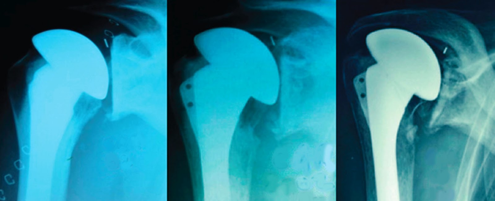 Shoulder Arthritis / Joint Replacement Secondary Rotator Cuff