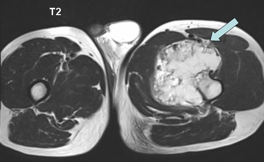mricases: Large Sessile Osteochondroma Of The Lesser Trochanter Of
