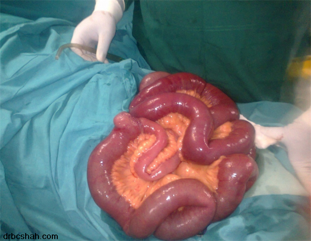 Lipoma Excision - American Family Physician