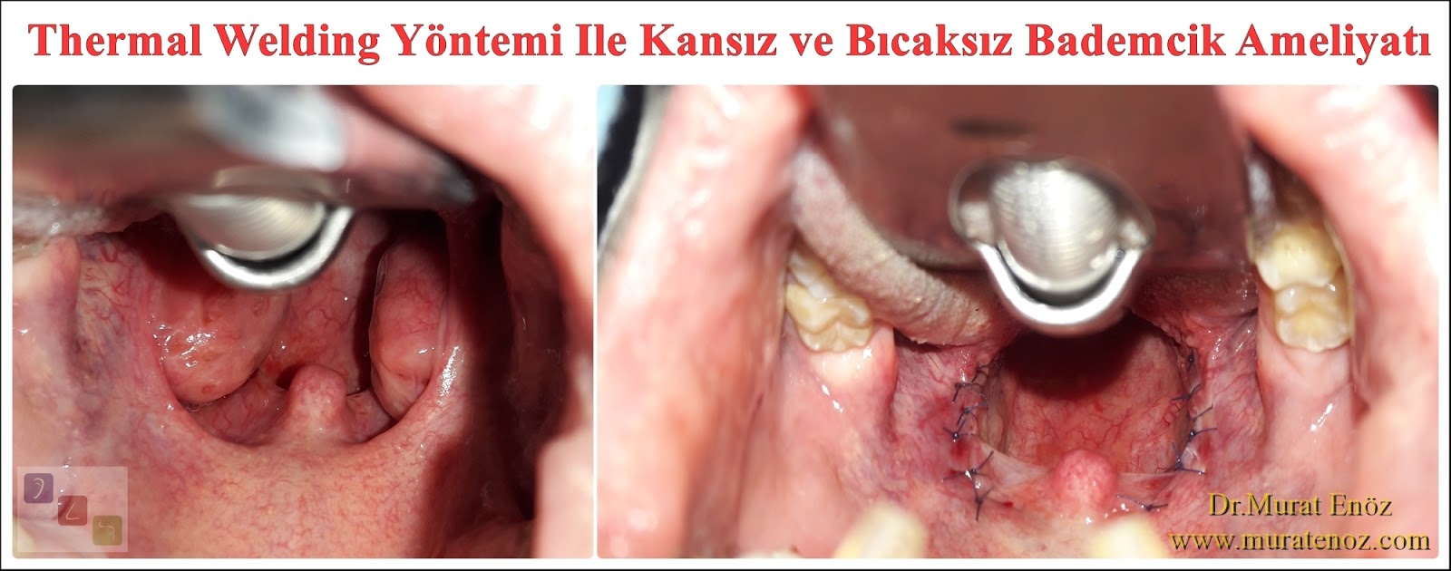 bademcik tasi magma ve uyku apnesi sendromu belirtileri olan hastamiza thermal welding yontemi ile bademcik ameliyati yaptik