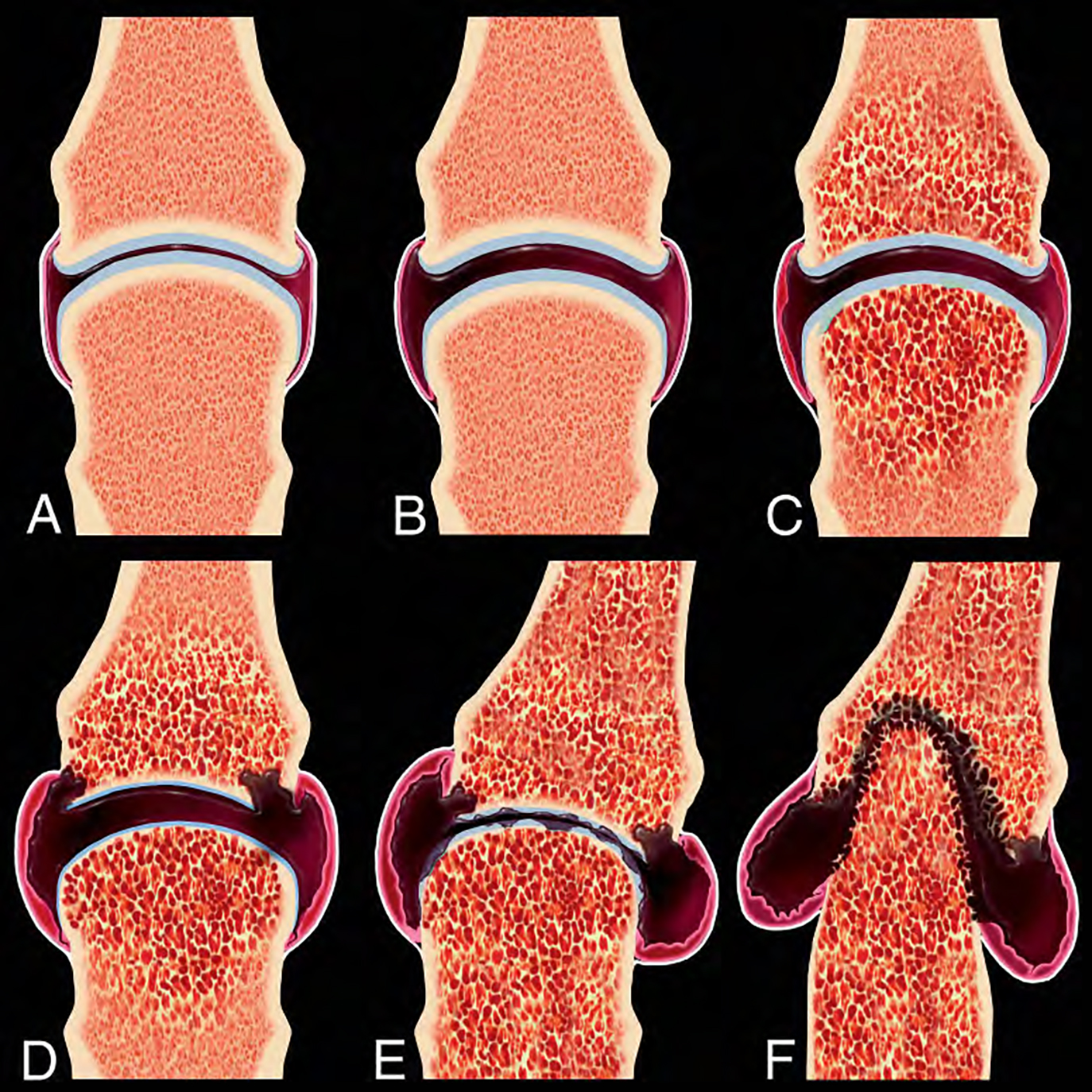 Rheumatoid Arthritis of Wrist and Hand