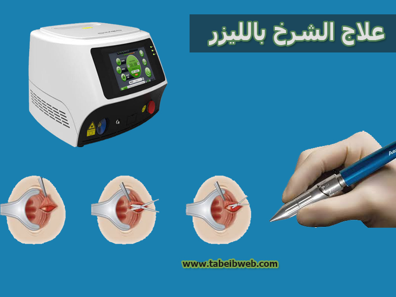 علاج الشرخ بالليزر طبيب ويب