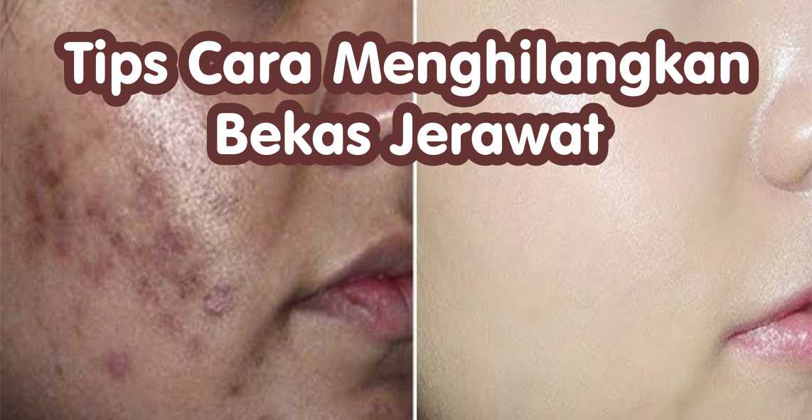 Tips Untuk Menghilangkan Bekas Jerawat Tips Untuk Menghilangkan Bekas Jerawat
