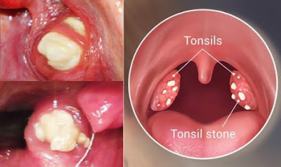 4 Effective Ways to Remove Tonsil Stones without Surgery - 3inaa