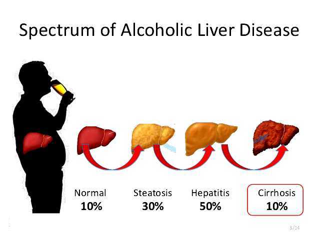 Alcoholic Liver Disease