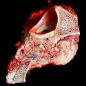 Ewing sarcoma