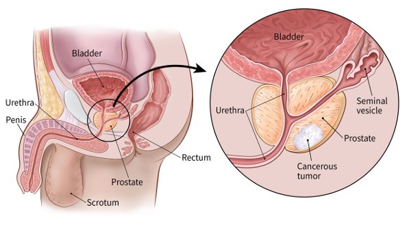 Risiko penyakit kanser prostat yang paling kerap berlaku kepada kesihatan suami