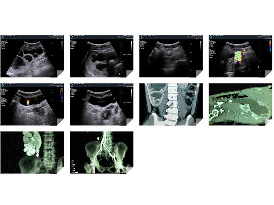 VIETNAMESE MEDIC ULTRASOUND CASE 436 SOLITARY KIDNEY, Dr PHAN THANH
