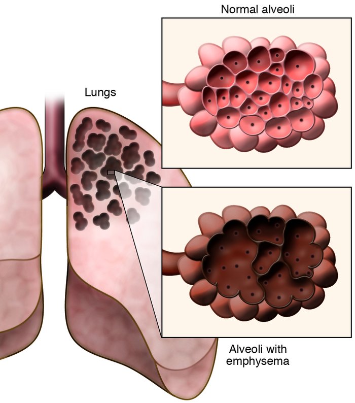 Эмфизема легких что это причины. Внутридольковая эмфизема. Осложнения при эмфиземе. Альвеолярная эмфизема легких курильщика. Экспираторная эмфизема.