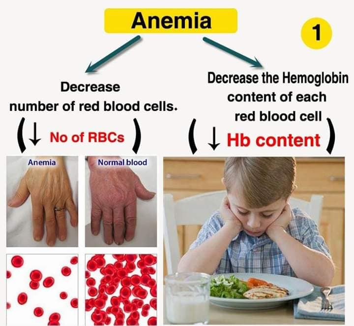 Anemia