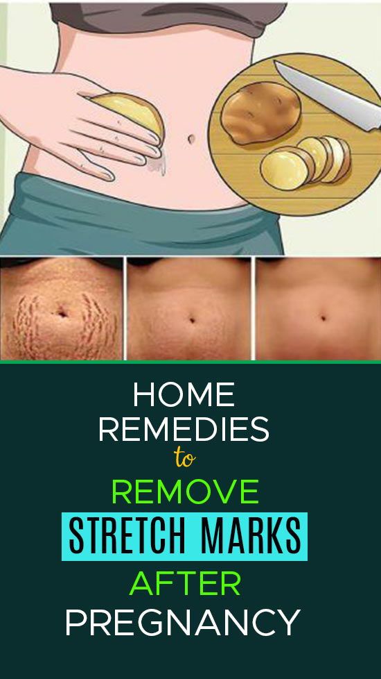 How To Remove Stretch Marks After Pregnancy 16 Home Remedies & Medical