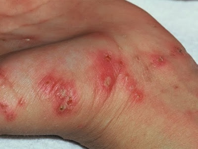 http://daffaran.blogspot.com/2017/02/tips-menjaga-diri-dari-penyakit-kulit.html