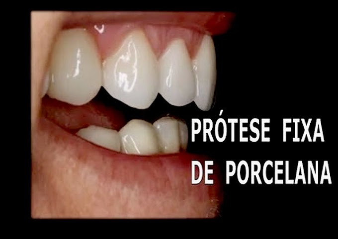 PRÓTESE DENTAL: Prótese fixa de Porcelana com Implantes