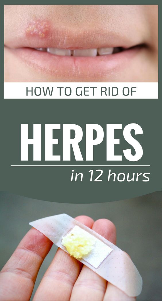 LIFE AT FIT Home Remedy To Get Rid Of Herpes In 12 Hours