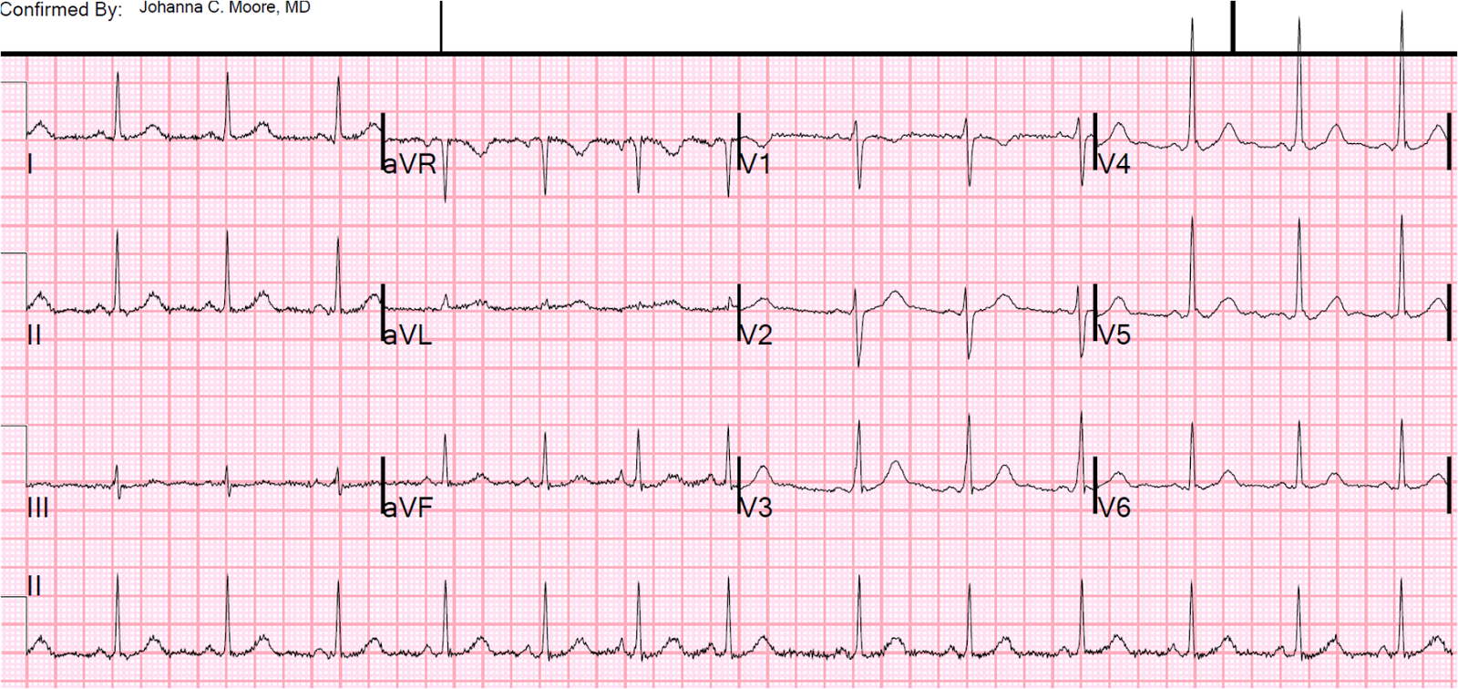 Dr. Smith's ECG Blog Wide Complex Tachycardia, and What is Latent