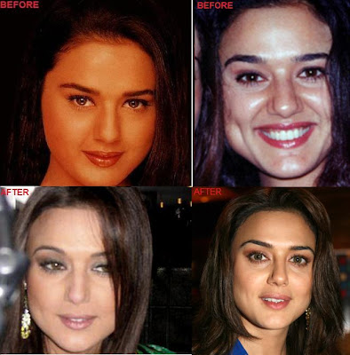Bollywood actress Preity Zinta before and after photos (seems she had many facial surgery in order to beat the level No.1 position.) Can you guys notice where are the changes on her face? Just notice the differences of her before and after cheeks. She reduced her puffy cheeks to look more stunning however she never thought that this will be the end of her Career in Bollywood as an actress. After her Bad facial cosmetic surgery, now she is focusing   on producing and directing movies.