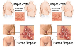 Obat-tradisional-herpes-simpleks