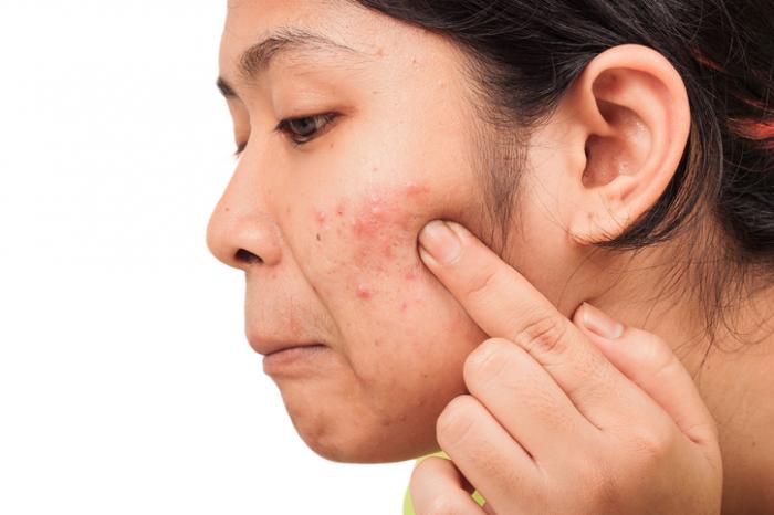 Use These Simple Home Remedies To Get Rid Of Acne Overnight