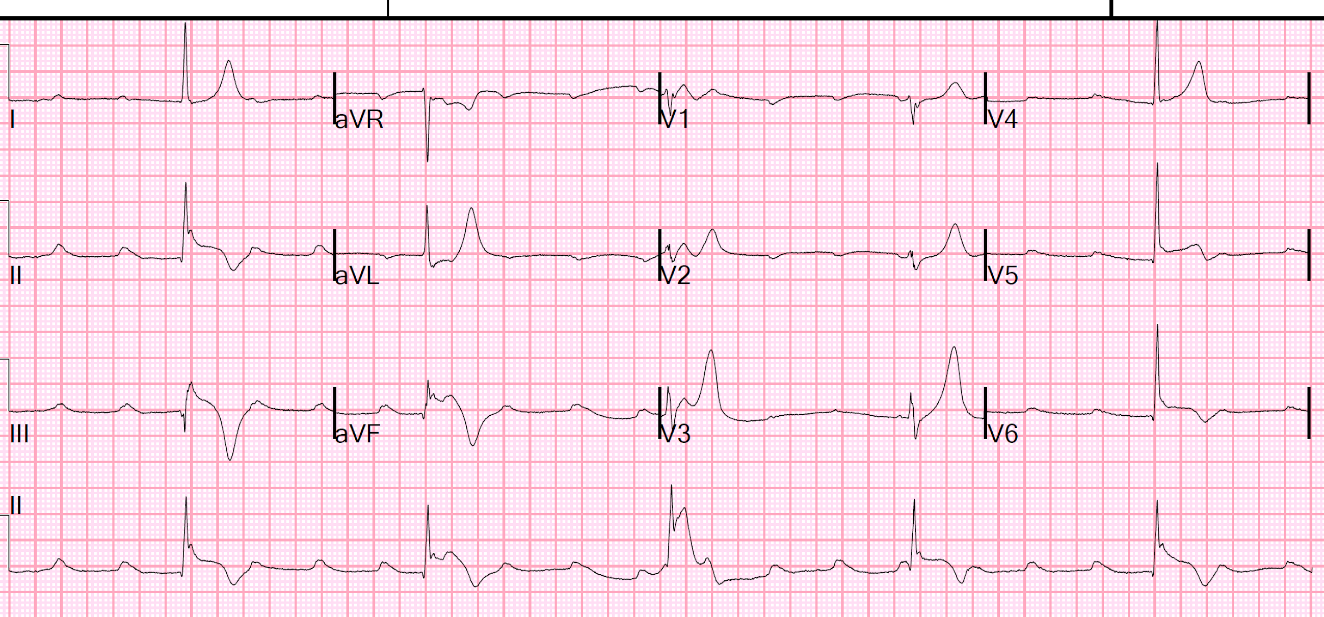 Dr. Smith's ECG Blog Hyperkalemia is it the cause of this AV Block, ST Elevation, and Twave