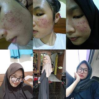 Perjuangan Melawan Jerawat Dengan Skincare di Bawah 100k