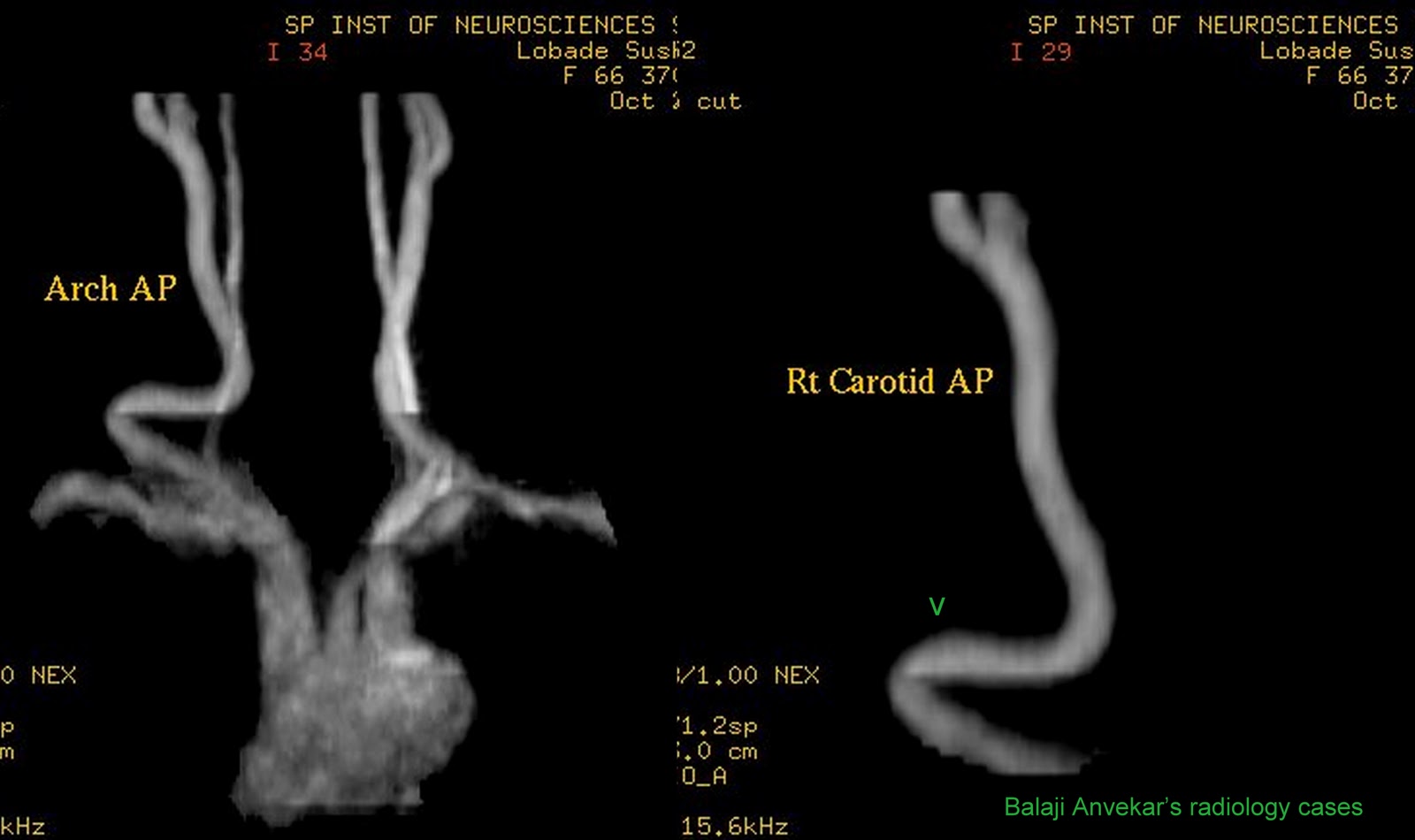 Dr Balaji Anvekar FRCR: Pulsatile Neck swelling due to Tortuous CCA