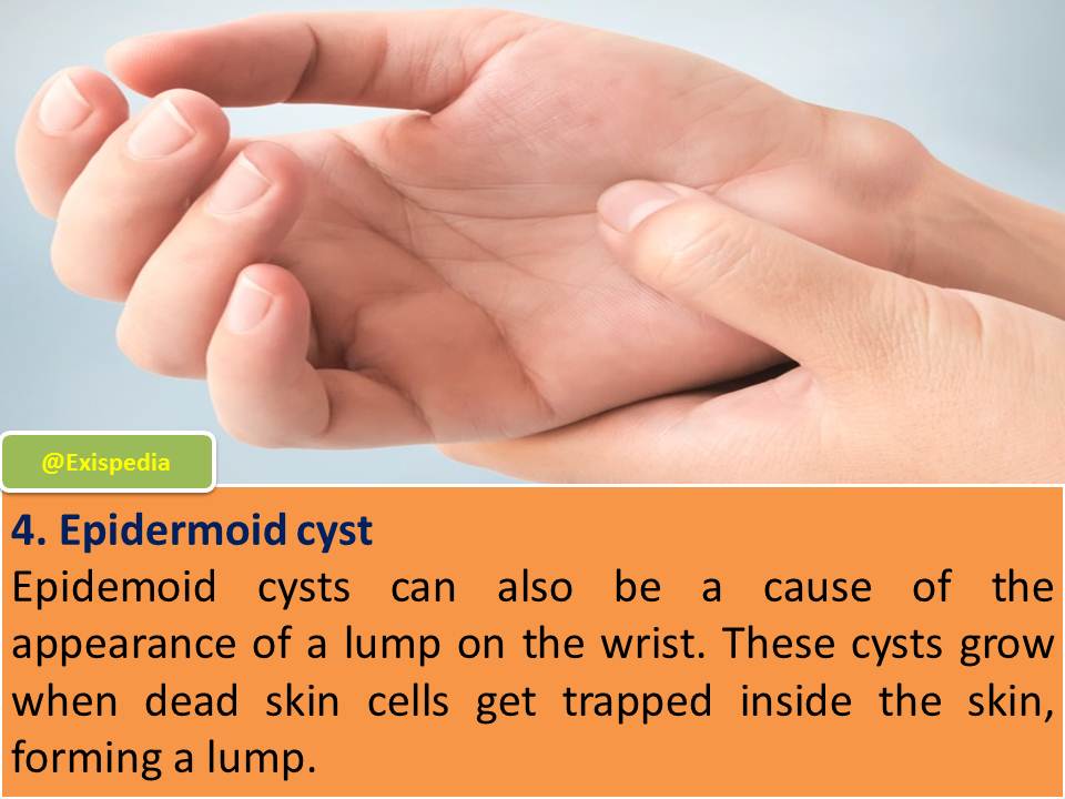 4 Common Types of Lumps on the Wrist Exis Pedia